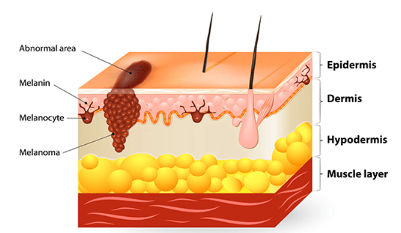 Melanoma Dectection
